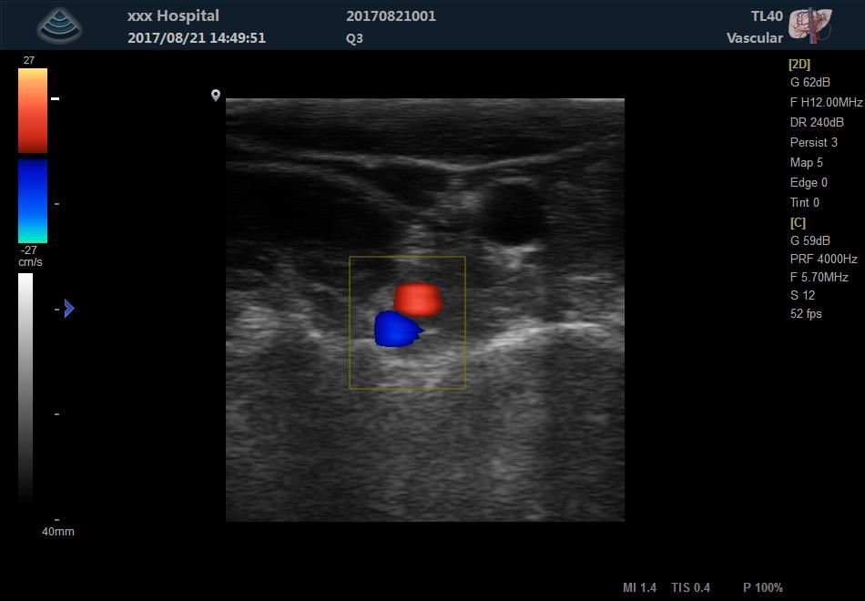 Zoncare-Q3 - Цифровой стационарный УЗИ аппарат с цветным