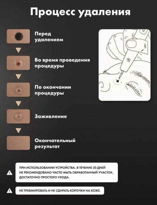 Электронная ручка коагулятор для удаления папилом и тату