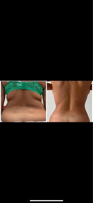 Lipoliză Injectabilă Fără Ac