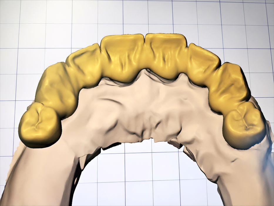 Дигитален Дизайн на Зъбопротезни конструкции от Зъботехник чрез Exocad