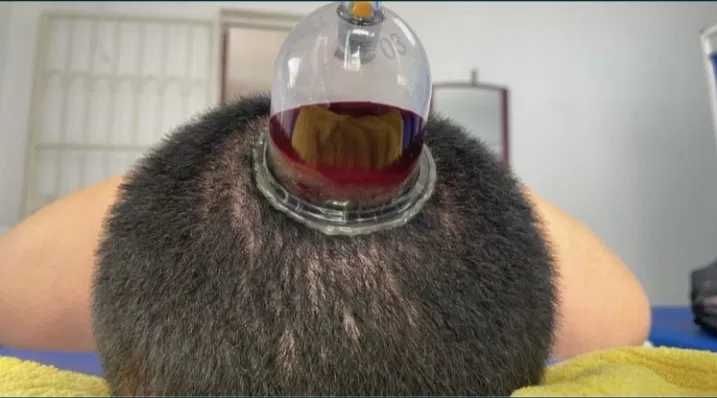 Хиджама. Шертпе. Кровопускание