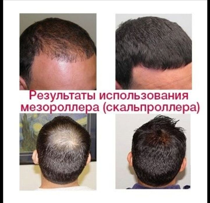 Мезароллер оригинал 2мм