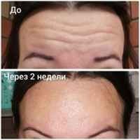 Ботокс мезаботокс фуллфейс