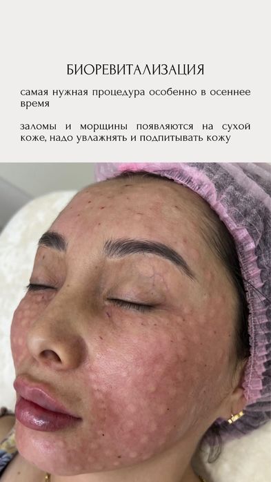 Плазмалифтинг, увеличение губ