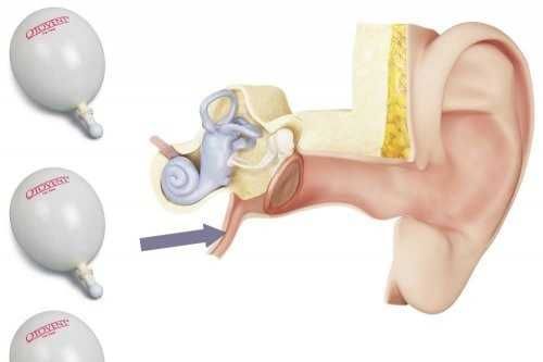 OTOVENT pentru tratamentul Otitei Seroase set 10 balonase