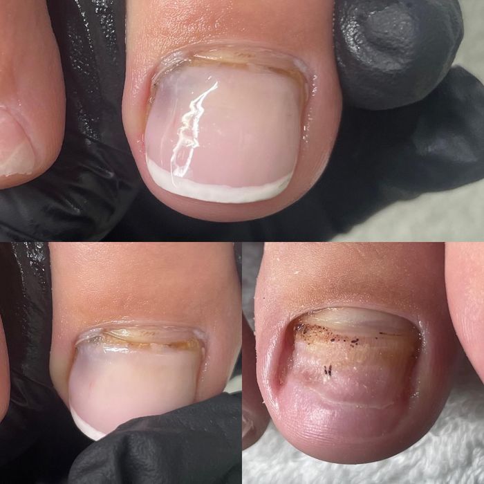 Pedichiură Medicală