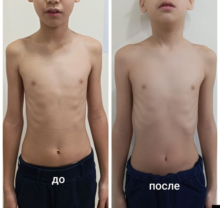 Хиджама - Остеотатия