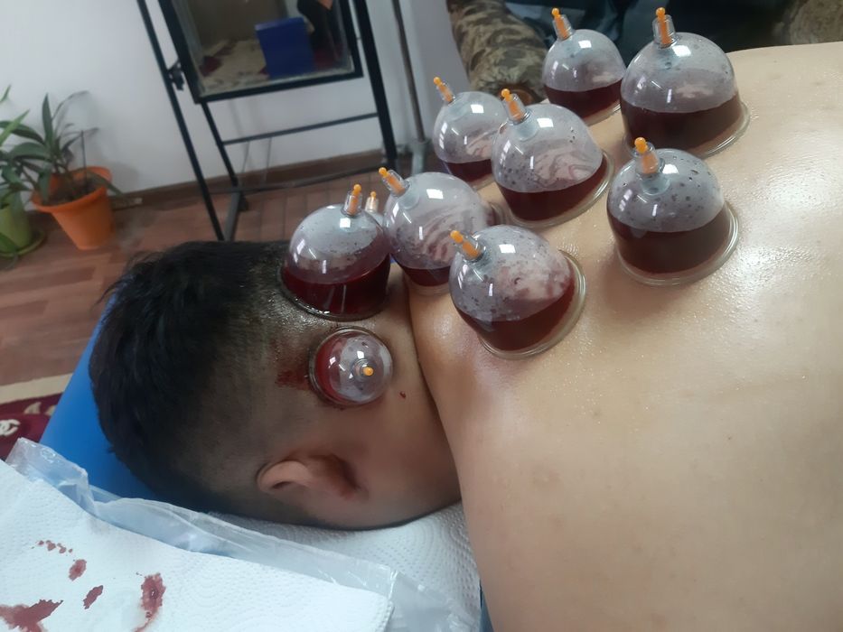Хиджама лечение кровопусканием