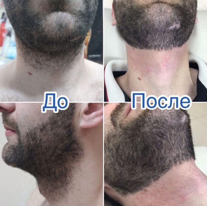 Мужской шугаринг, бритье