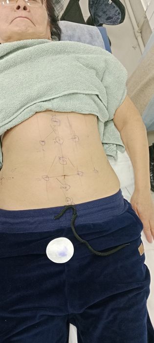 Массаж хиджама иглотерапия