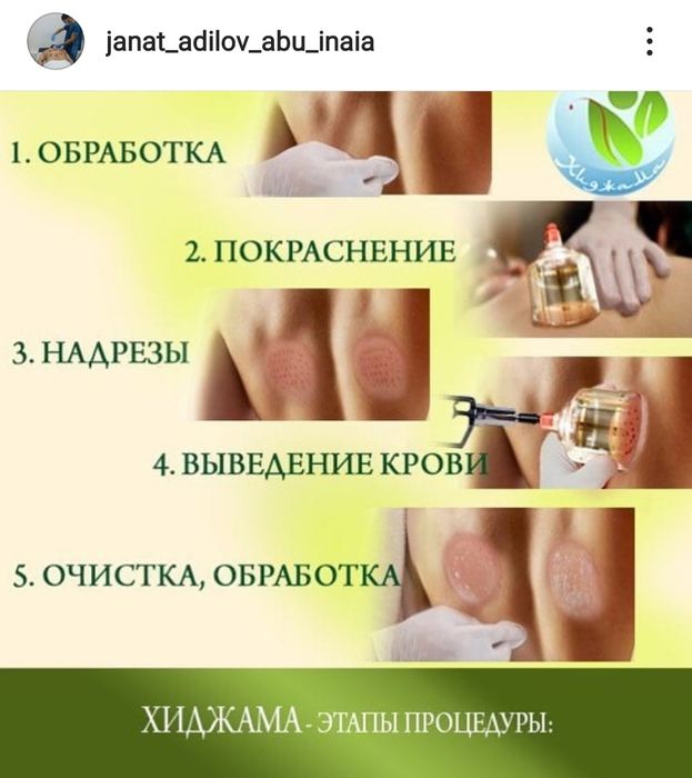 Кровопускание Хиджама Павлодар