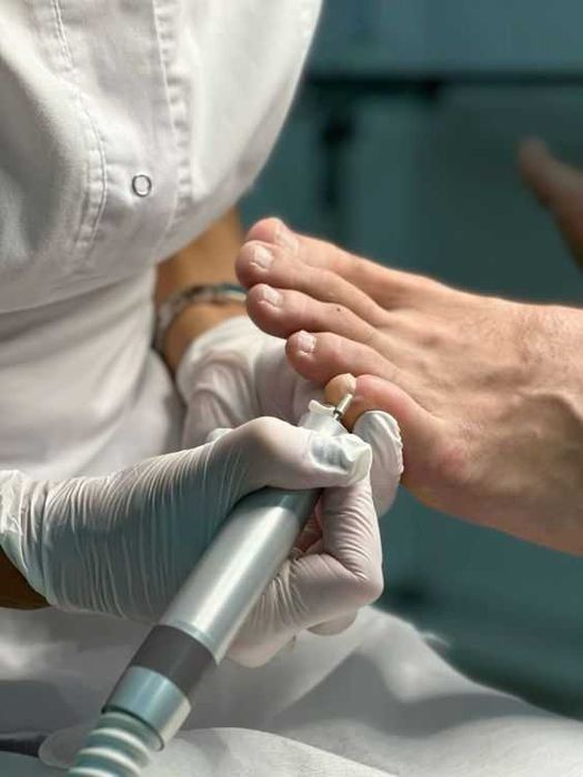 Подолог, услуги подолога, вросший ноготь