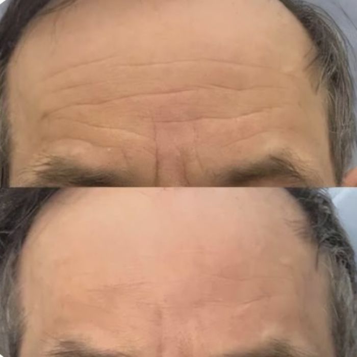 Ботокс,Траптокс,Гипергидроз.Botoks, Traptoks, Qùltiq terlash, gipergid