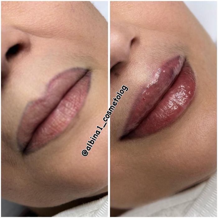 Нужны модели на увеличение губ! Оплата за препарат