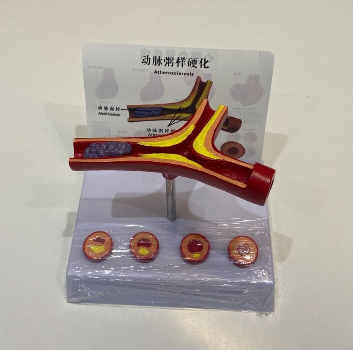 Муляж атеросклероз сосудов маникен