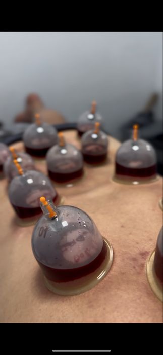 Хиджама профессиональная