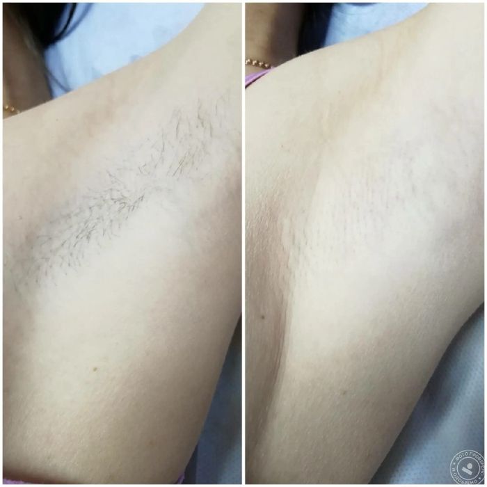 ШУГАРИНГ Сахарная депиляция