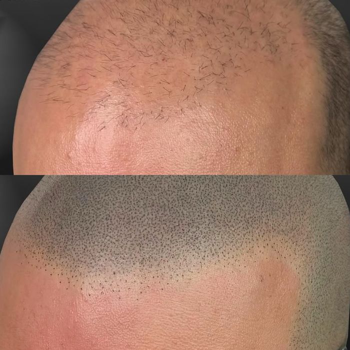 Curs SMP micropigmentare scalp fizic sau online