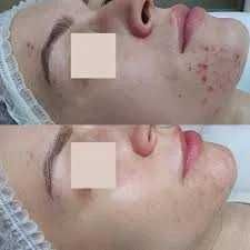 Пиллинг BioRePeel, флакон 6мл (на 5-6 процедур). Италия 100% оригинал!