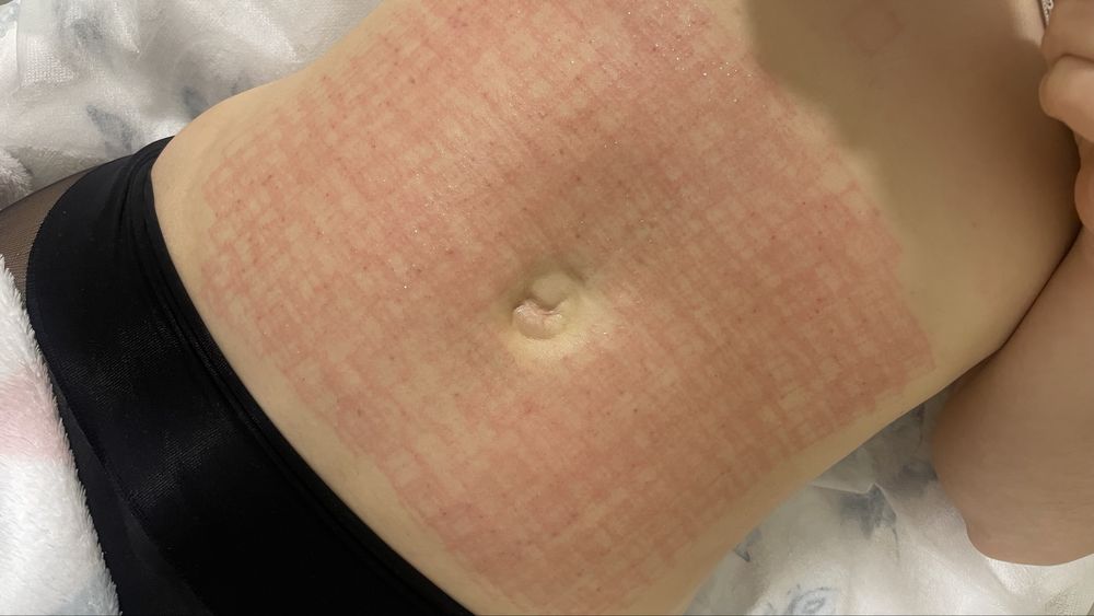 Аппарат микроигольчатый RF