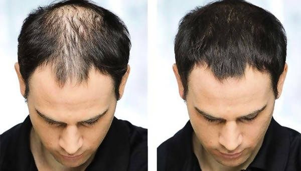 Toppik hair fiber топик загуститель для волос sochni to'ldirish uchun