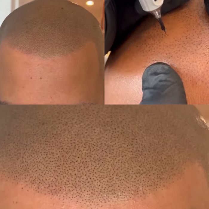 Curs de Micropigmentare Scalp și Barba - Dermopigmentare SMP Academie