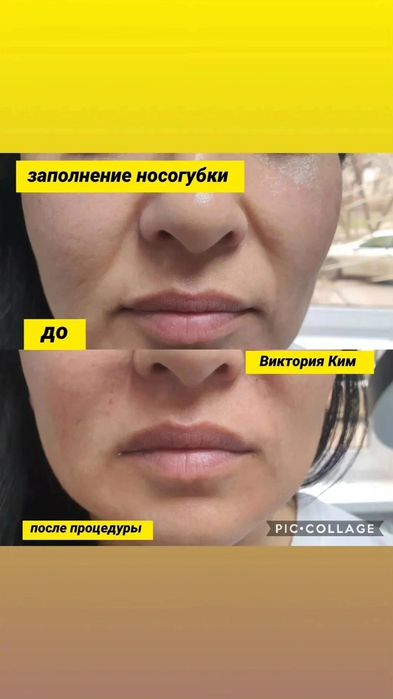 Увеличение губ заполнение носогубки