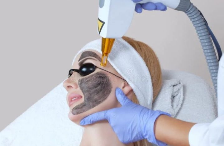 Карбоновый пилинг,7000  омоложение