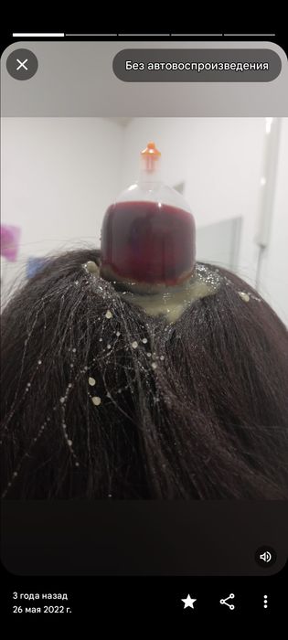 тиббий зулуклар медицинский пиявки гирудотерапия