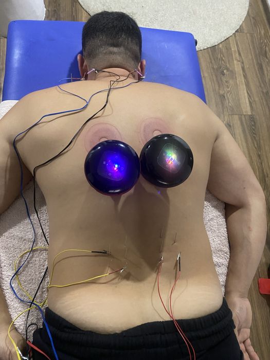Recuperare Neurologică, Chiropractica,Acupunctură, Cupping( Ventuze)