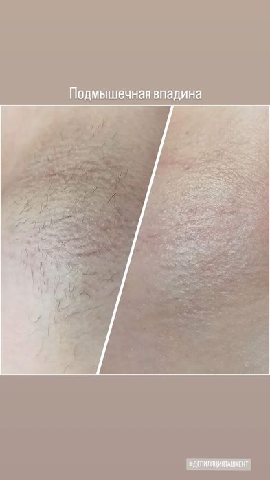 Профессиональная депиляция шугаринг, полимерный воск