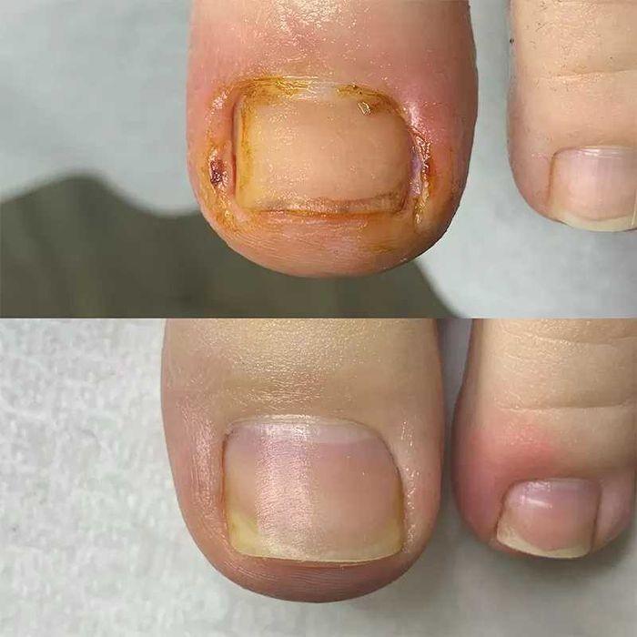 Afectiuni Unghii si Talpi - Podologie doar cu asistenti medicali