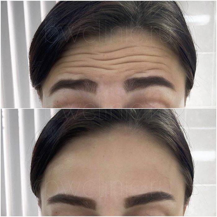 Акция Ботокс лица