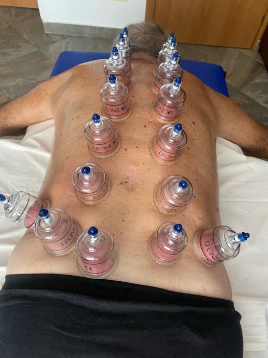 Recuperare Neurologica,Chiropractica,Acupunctura,Cupping(Ventuze)