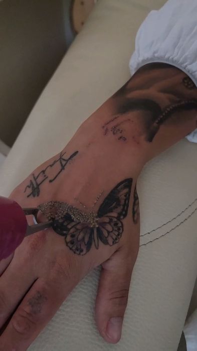 Stergere tatuaje cu fascicul laser tip picosecond