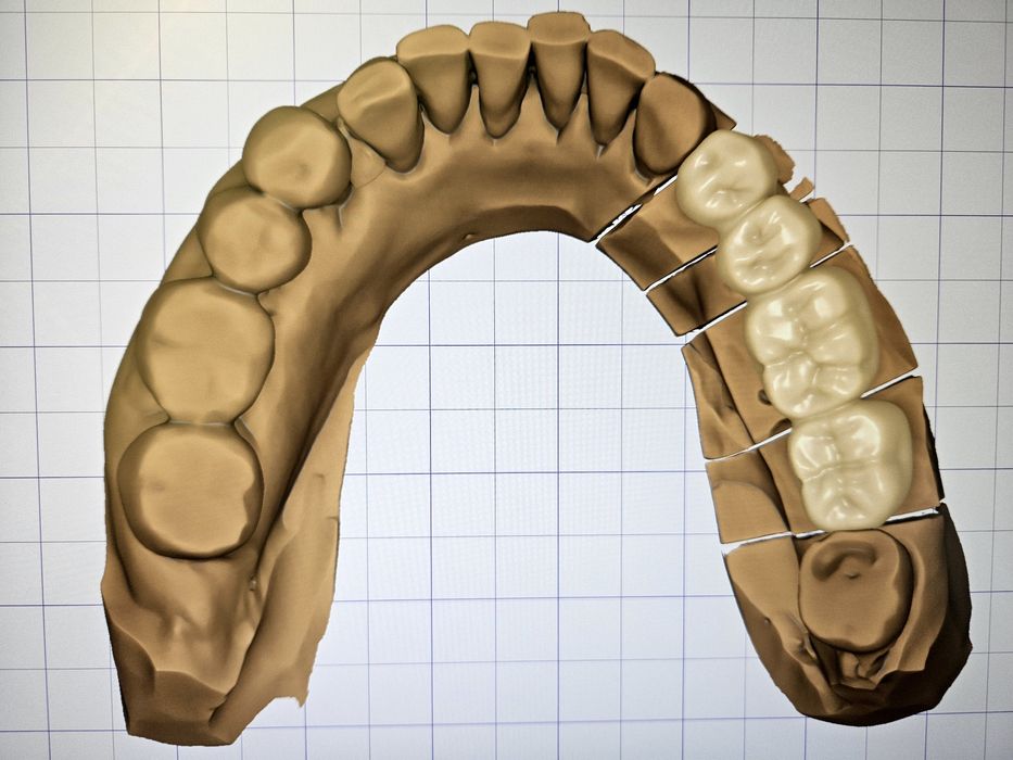Дигитален Дизайн на Зъбопротезни конструкции от Зъботехник чрез Exocad