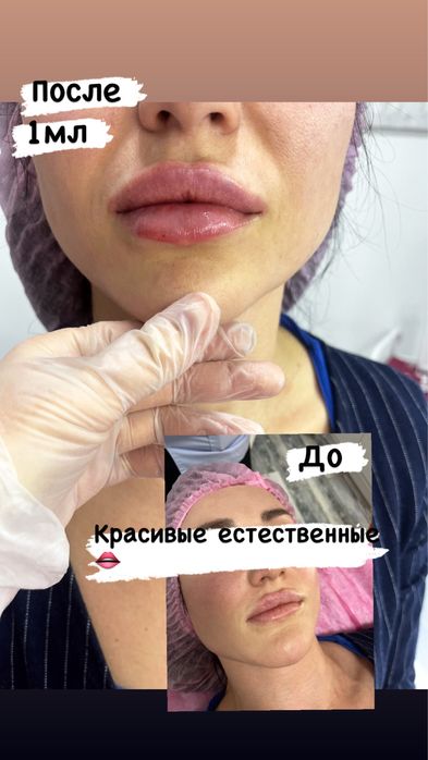Увеличение губ,мезо,ботокс 30.000