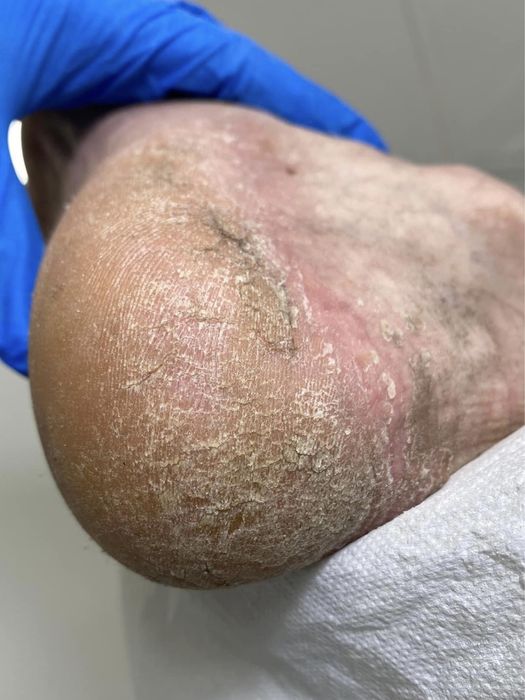 Pedichiură Medicală