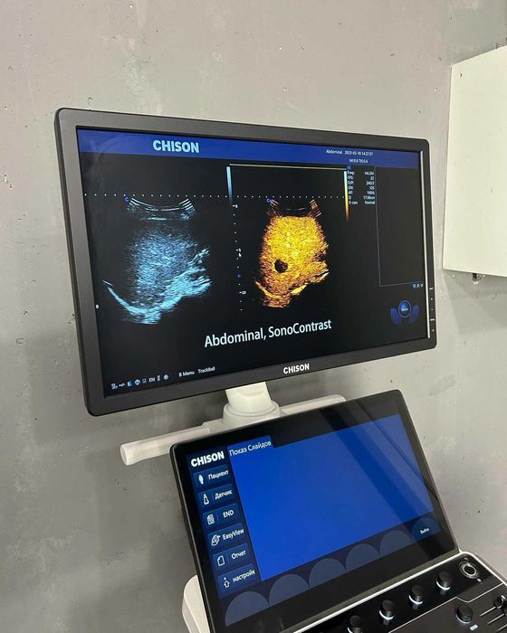 УЗИ аппарат Chison SonoMax, новый