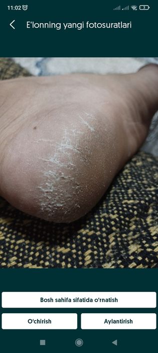 Tovon tirsak oyoq qoʻl yorilishini oldini olib va ulardan xalosboʻlish