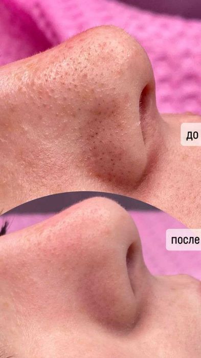 Kosmetologiya | Yuzni tozalash, parvarish, pilinglar