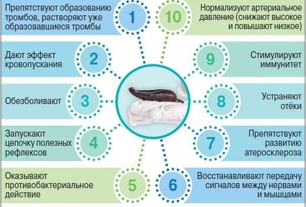 Лечение пиявками