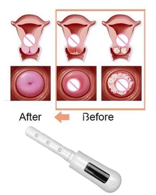 3D 360° Гинекологично Неинвазивна Лазерна Терапия Влагалищно Затягане Лазер Вагинално Стягане Вагинален Мускул Вагинално Подмладяване Стесняване