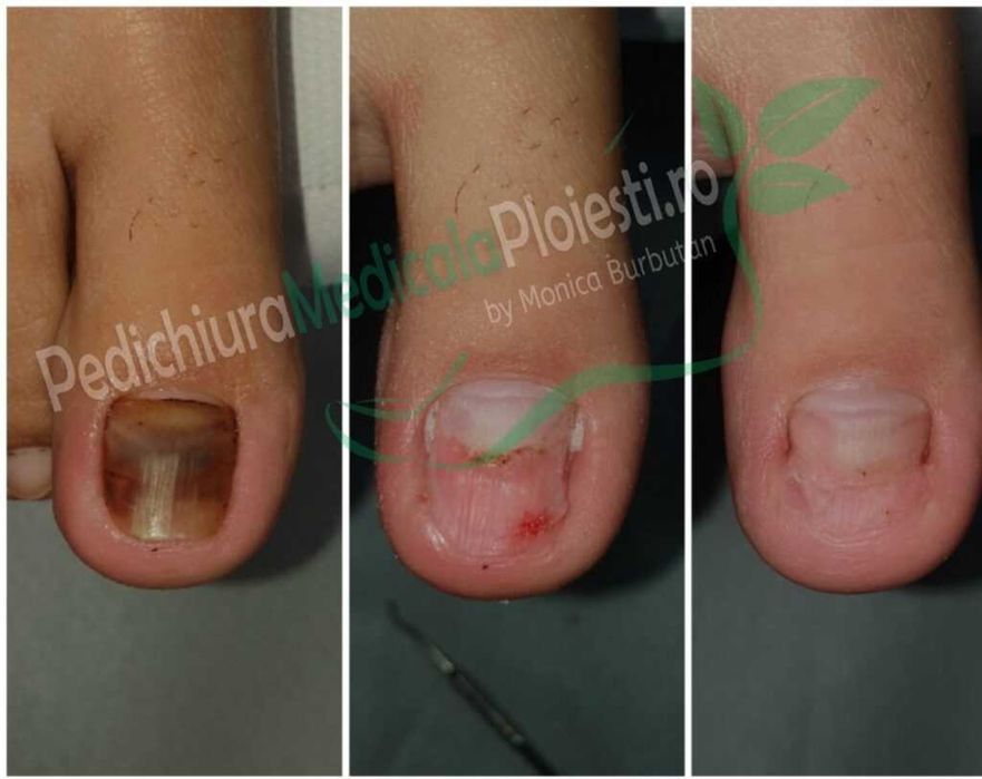 Pedichiura medicala/ Corectie unghii incarnate/ unghii dureroase