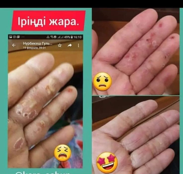 ҚАРА САҚАР сабын тері ауруларына таптырмас ем