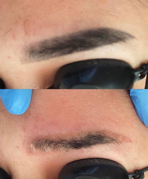 Лазер | Ботокс | Пилинги | Удаление татуажа | Косметолог