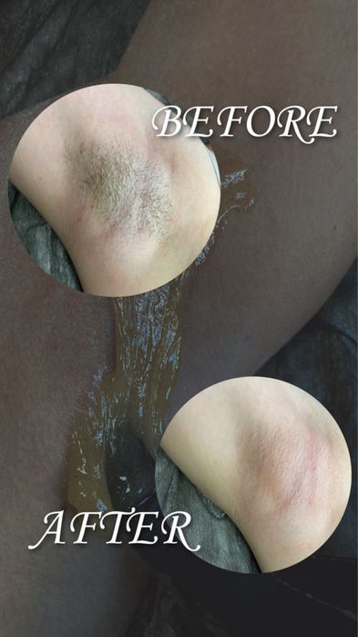 Depilyatsiya skidkada