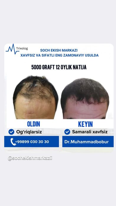 Soch ekish eng zamonaviy usul