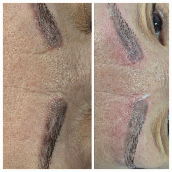 Удаление татуажа брови. 300 тысяч