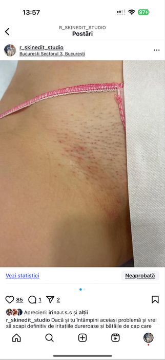 Epilare definitiva laser Bucuresti Sector 3 (zona trapezului)